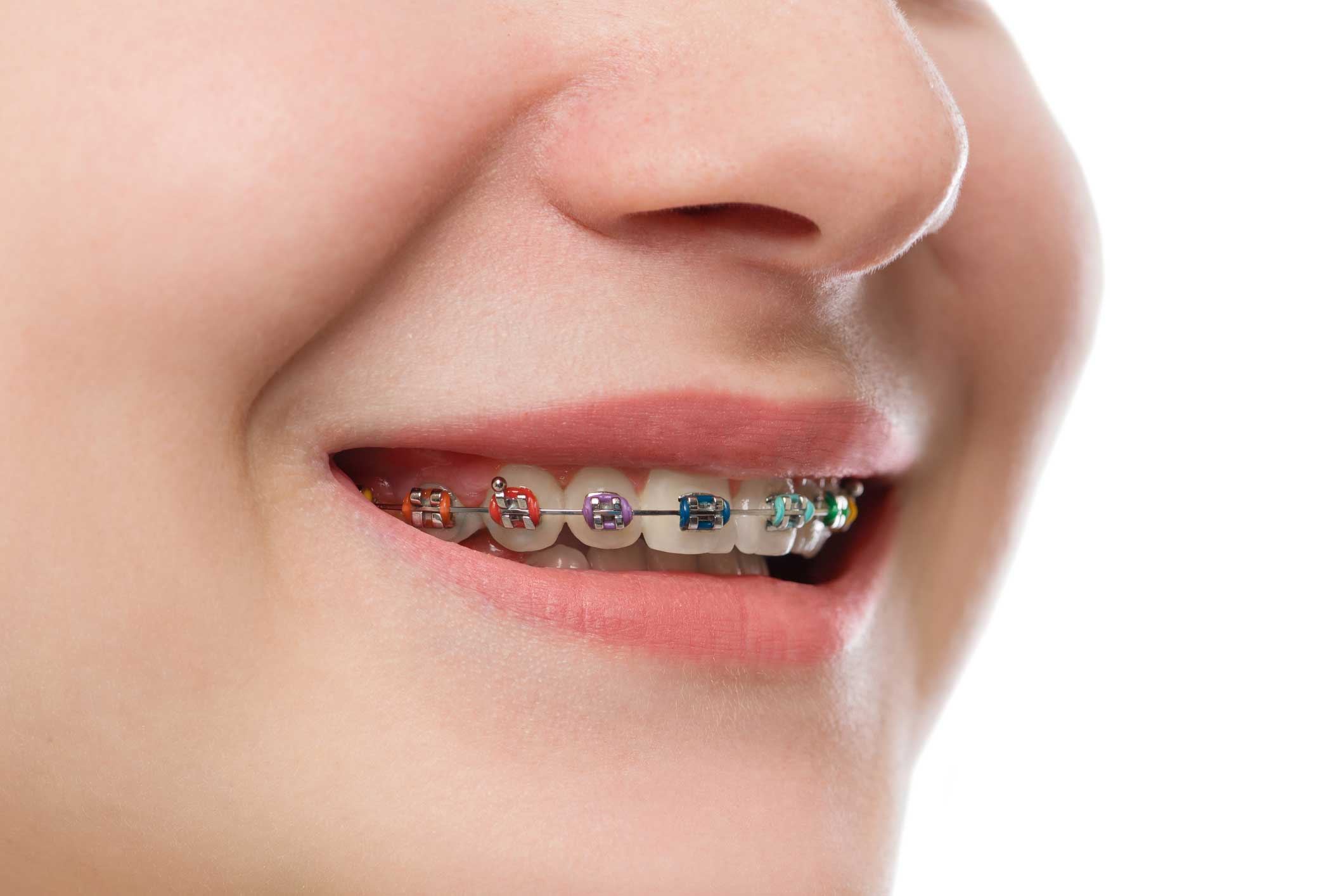 ortodoncia invisible en Valencia, dentista en Valencia, clínica dental en Valencia.