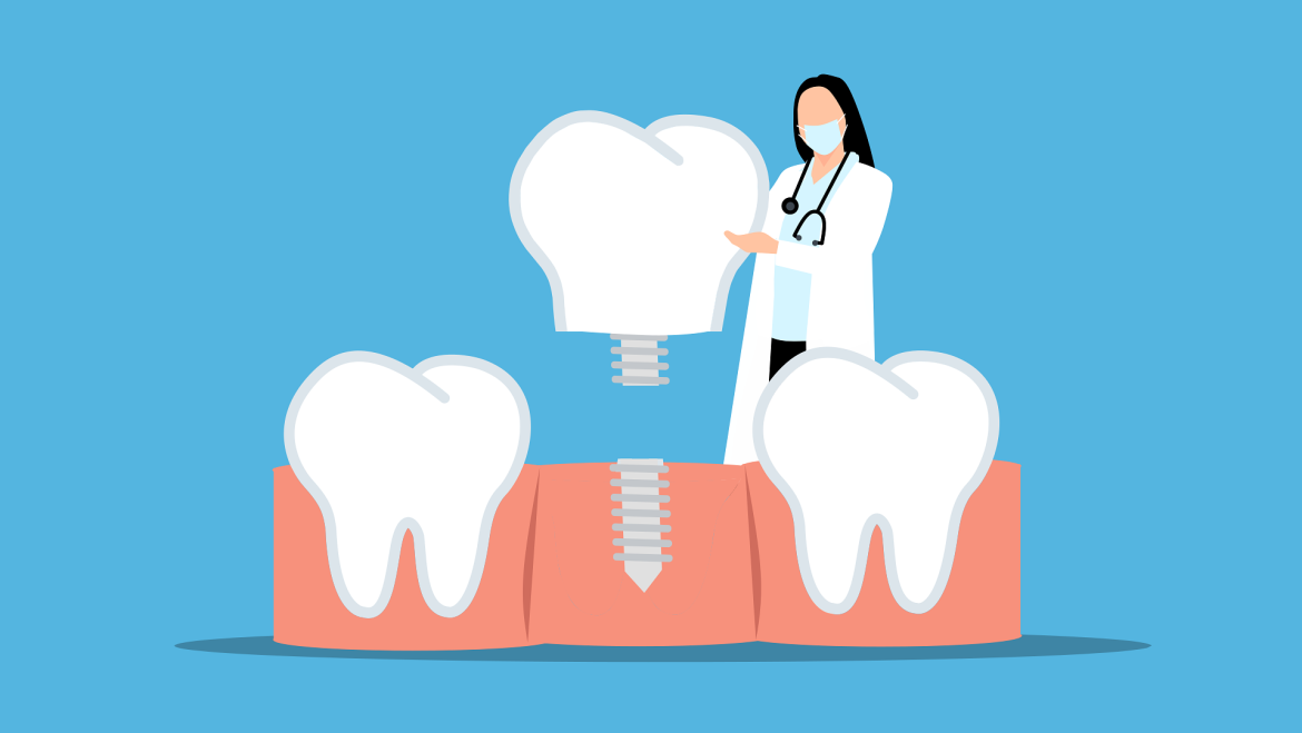 Implantes Inmediatos para restaurar su sonrisa de manera rápida y eficiente