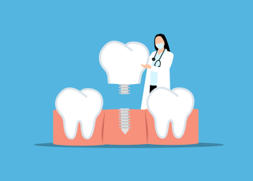 Implantes Inmediatos para restaurar su sonrisa de manera rápida y eficiente