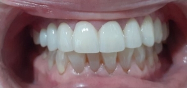 Razones para elegir una corona de Zirconio en lugar de Metal-Porcelana en una clínica dental