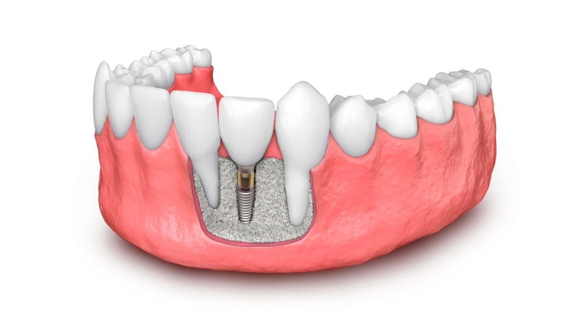 Elección de los implantes y del doctor que lo va a colocar en una clínica dental