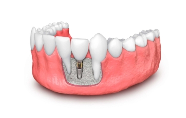 Elección de los implantes y del doctor que lo va a colocar en una clínica dental